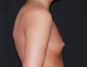 Breast Augmentation - Saline Implants Before & After Patient #20635