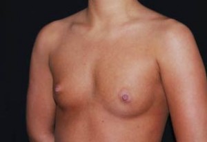 Breast Augmentation - Saline Implants Before & After Patient #20635