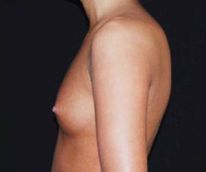 Breast Augmentation - Saline Implants Before & After Patient #20635