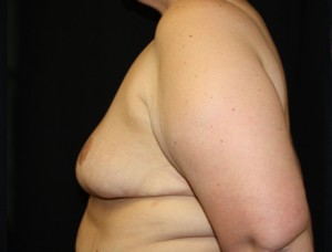 Breast Reduction Before & After Patient #23720