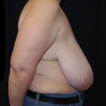 Breast Reduction Before & After Patient #23720