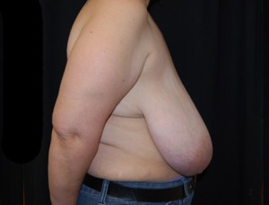 Breast Reduction Before & After Patient #23720