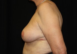 Breast Reduction Before & After Patient #23742
