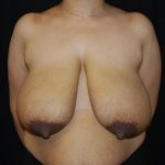 Breast Reduction Before & After Patient #23677