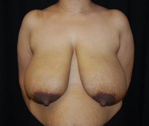 Breast Reduction Before & After Patient #23677