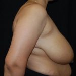 Breast Reduction Before & After Patient #23677