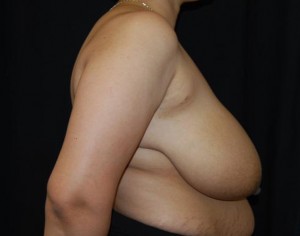 Breast Reduction Before & After Patient #23677