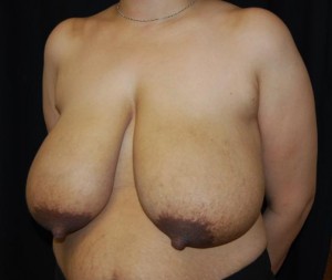 Breast Reduction Before & After Patient #23677