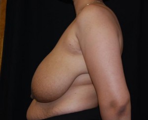 Breast Reduction Before & After Patient #23677