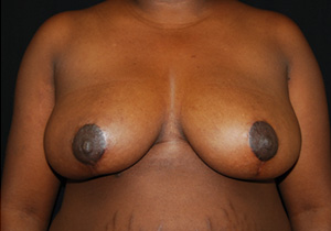 Breast Reduction Before & After Patient #23764