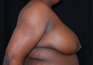 Breast Reduction Before & After Patient #23764