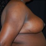 Breast Reduction Before & After Patient #23764
