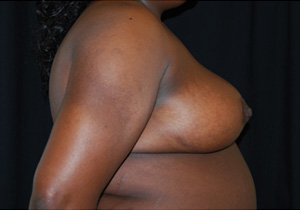 Breast Reduction Before & After Patient #23764