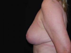 Breast Reduction Before & After Patient #23765