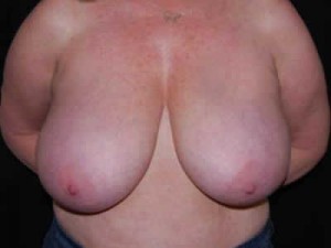 Breast Reduction Before & After Patient #23765