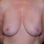 Breast Reduction Before & After Patient #23765