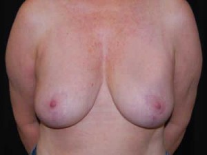 Breast Reduction Before & After Patient #23765