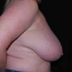 Breast Reduction Before & After Patient #23765