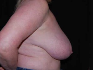 Breast Reduction Before & After Patient #23765