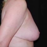 Breast Reduction Before & After Patient #23765