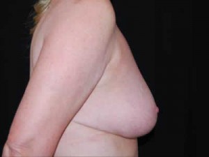 Breast Reduction Before & After Patient #23765