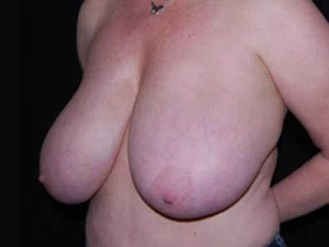 Breast Reduction Before & After Patient #23765
