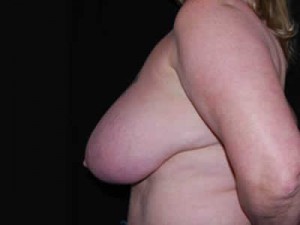 Breast Reduction Before & After Patient #23765