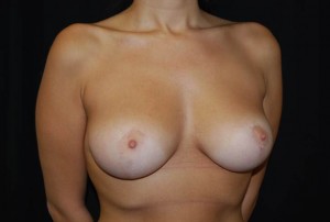 Breast Reduction Before & After Patient #23610