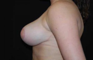 Breast Reduction Before & After Patient #23654