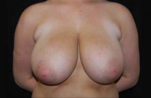 Breast Reduction Before & After Patient #23654