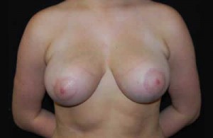 Breast Reduction Before & After Patient #23654