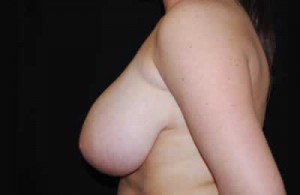 Breast Reduction Before & After Patient #23654
