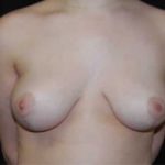 Breast Reduction Before & After Patient #23782