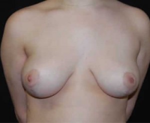 Breast Reduction Before & After Patient #23782