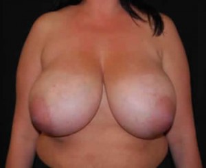 Breast Reduction Before & After Patient #23783