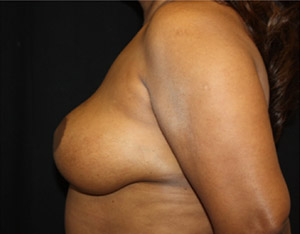 Breast Reduction Before & After Patient #23842