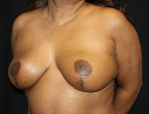 Breast Reduction Before & After Patient #23842