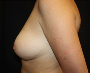 Breast Reduction Before & After Patient #23843