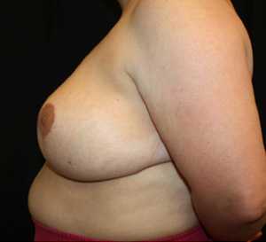 Breast Reduction Before & After Patient #23864