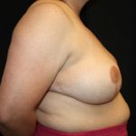 Breast Reduction Before & After Patient #23864