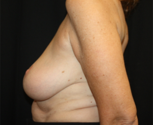 Breast Reduction Before & After Patient #23865