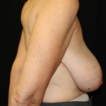 Breast Reduction Before & After Patient #23865