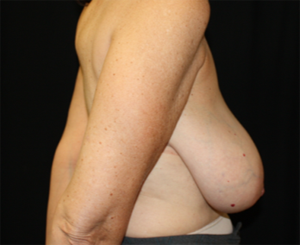 Breast Reduction Before & After Patient #23865