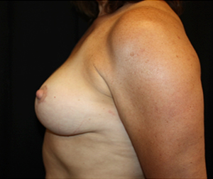 Breast Reduction Before & After Patient #23885