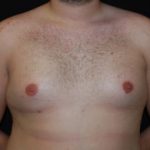 Gynecomastia Before & After Patient #23321