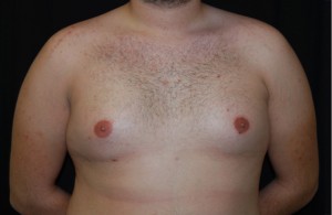 Gynecomastia Before & After Patient #23321