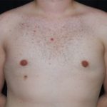 Gynecomastia Before & After Patient #23321