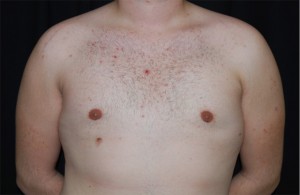 Gynecomastia Before & After Patient #23321