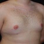 Gynecomastia Before & After Patient #23321