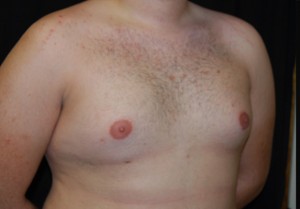 Gynecomastia Before & After Patient #23321